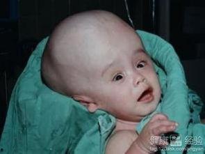 脑积水可以吃酥瓜吗视频,脑积水患者适宜食用酥瓜的健康指南